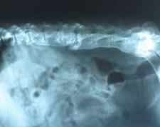 Röntgen Spondyloartrose