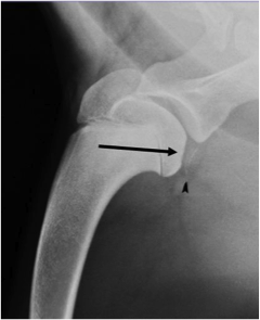 OCD – Osteochondritis dissecans