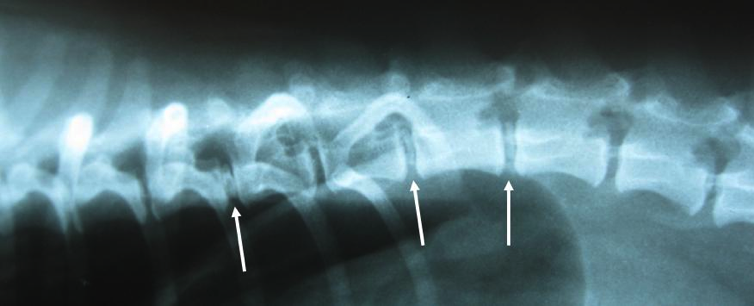 Hernia van de tussenwervelschijf  - Hernia nuclei pulposi