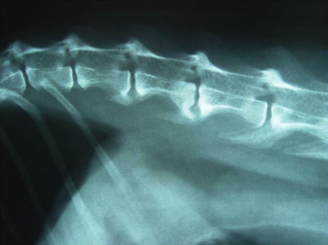 CAUDA EQUINA SYNDROOM  & OCD van het heiligbeen